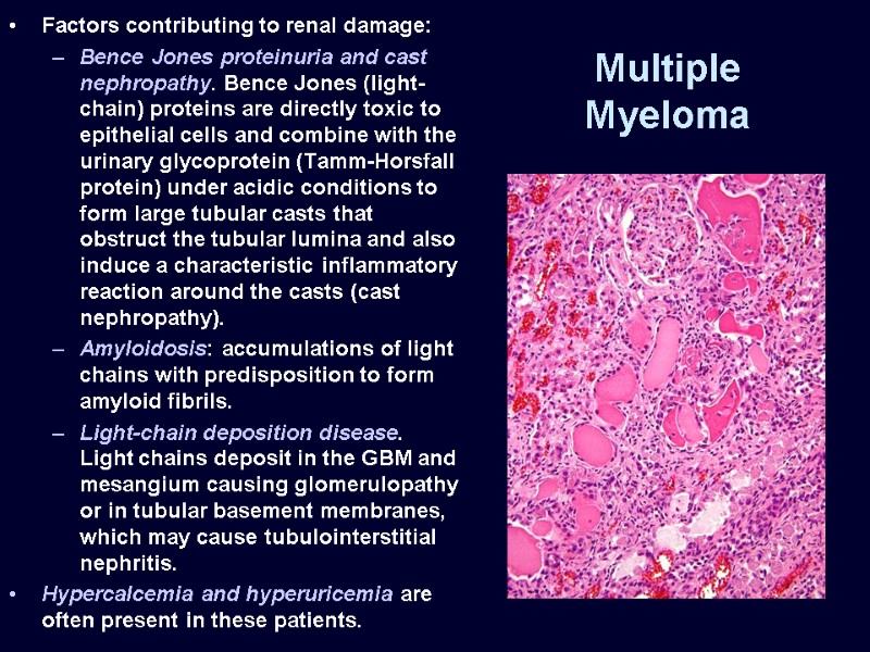 Multiple Myeloma Factors contributing to renal damage:  Bence Jones proteinuria and cast nephropathy.